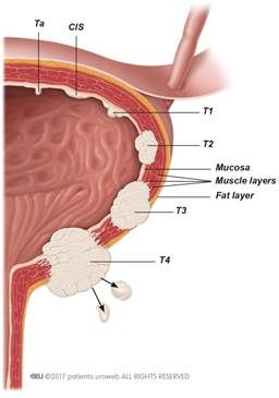 Treatment of muscle-invasive bladder cancer - Patient Information